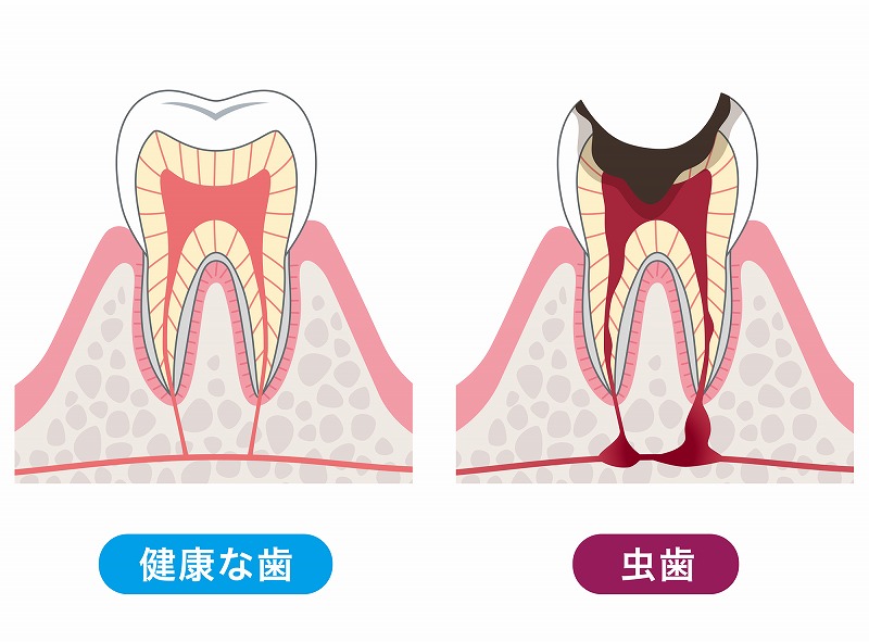 むし歯の原因