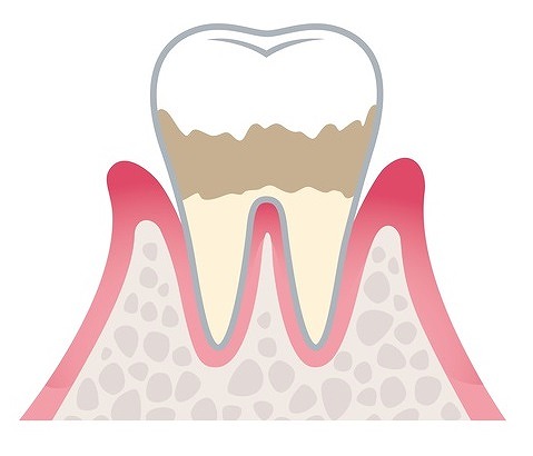 軽度歯周炎（歯周ポケットの深さ3～4mm）